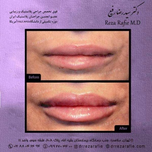تزریق-ژل-لب-1