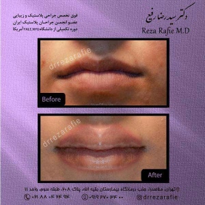 تزریق-ژل-لب-2