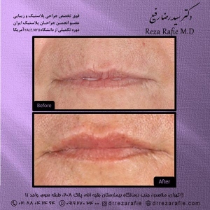 تزریق-ژل-لب-3