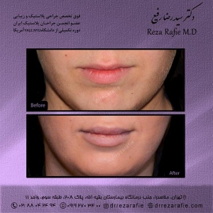 تزریق-ژل-لب-4