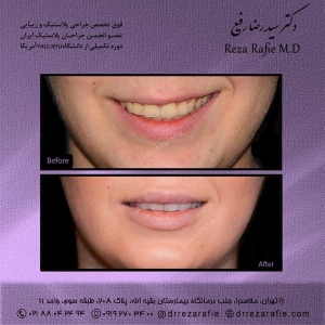 تزریق-ژل-لب-5