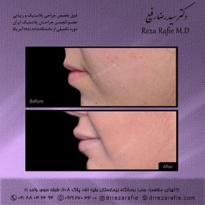 تزریق-ژل-لب-6