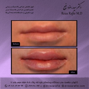 تزریق-ژل-لب-7