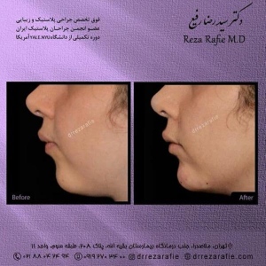 تزریق-ژل-10
