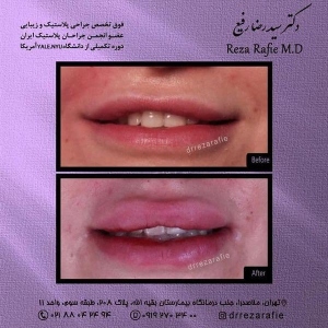 تزریق-ژل-11
