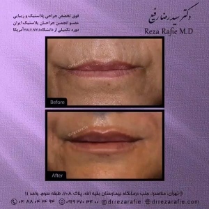تزریق-ژل-13