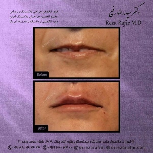تزریق-ژل-15