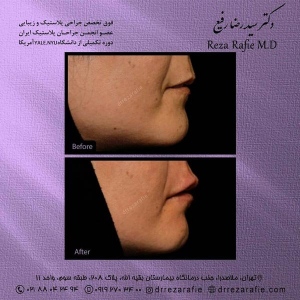 تزریق-ژل-16