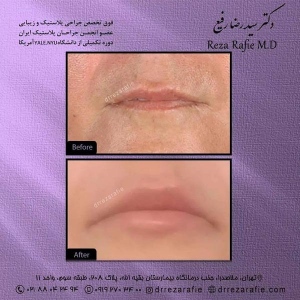 تزریق-ژل-17