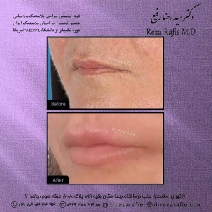 تزریق-ژل-18