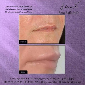 تزریق-ژل-19