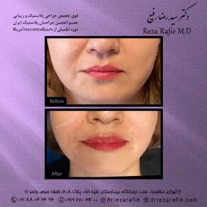 تزریق-ژل-20