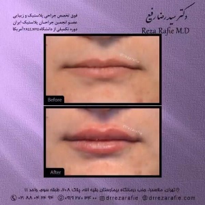 تزریق-ژل-22