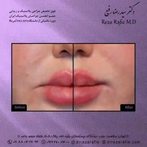 تزریق-ژل-23