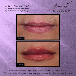 تزریق-ژل-24