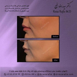 تزریق-ژل-8