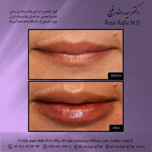 تزریق-ژل-9