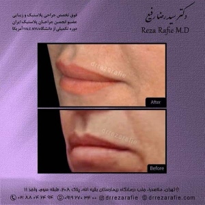 تزریق_ژل_12
