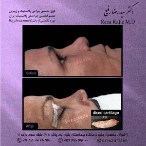 جراحی-پلک-1