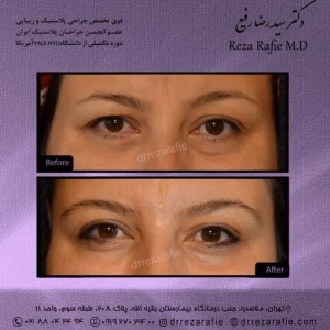 جراحی-پلک-10