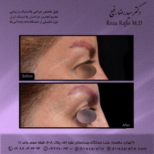 جراحی-پلک-11