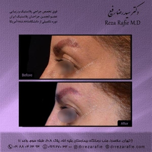 جراحی-پلک-12