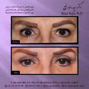 جراحی-پلک-14