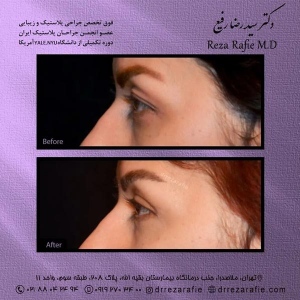 جراحی-پلک-15