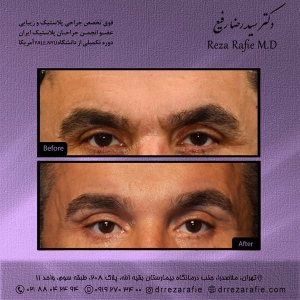 جراحی-پلک-8