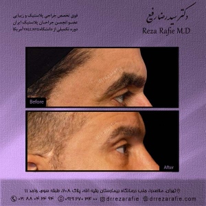 جراحی-پلک-9
