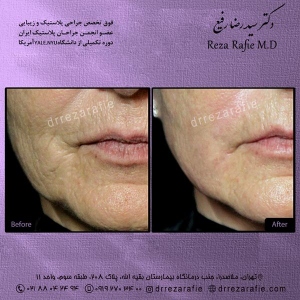 میکروبوتاکس