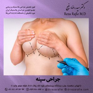 جراحی سینه- دکتر رفیع