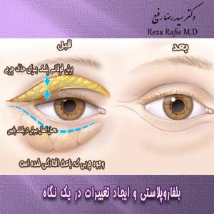 جراحی پلک-دکتر رضا رفیع
