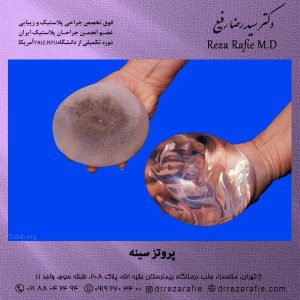 پروتز سینه در تهران