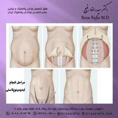 ابدویمنوپلاستی در تهران - دکتر رفیع 