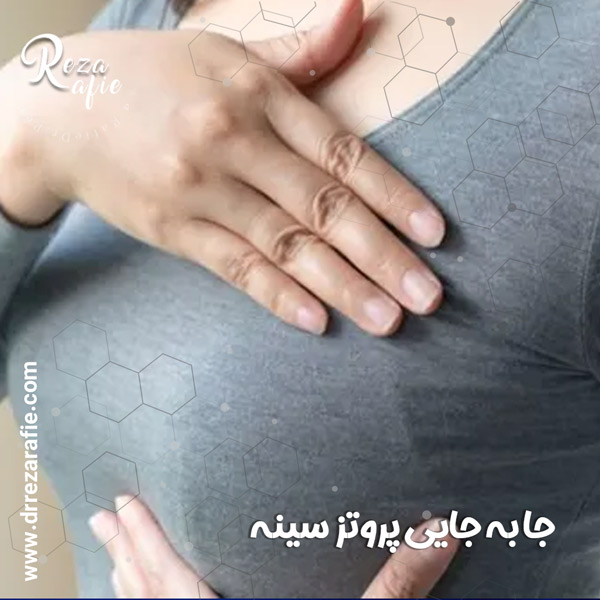 جا به جایی پروتز سینه - دکتر رفیع