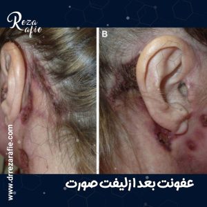 عفونت بعد از لیفت صورت