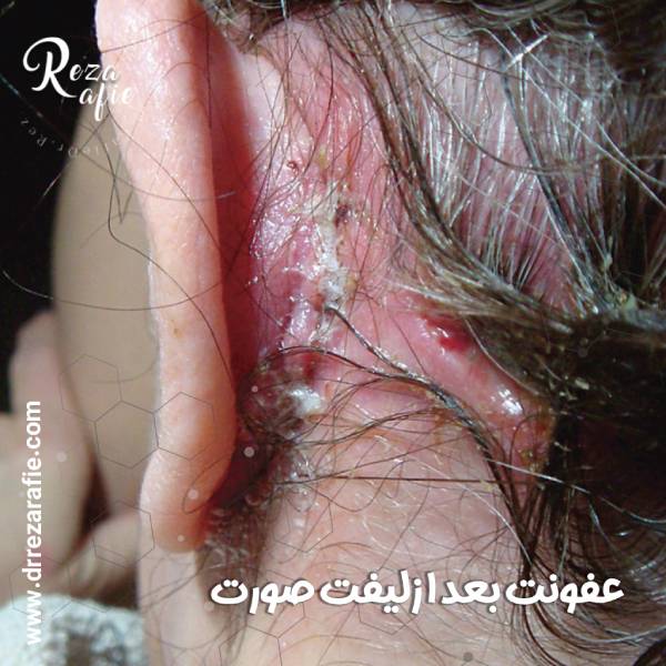 عفونت بعد از لیفت صورت