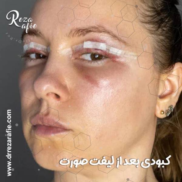 کبودی بعد از لیفت صورت