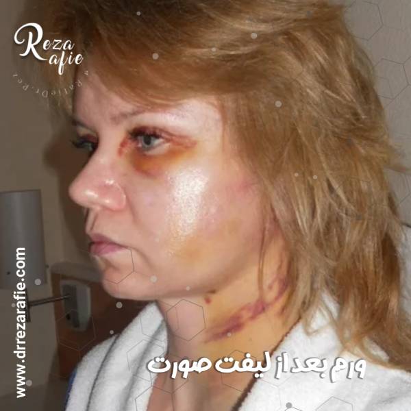 ورم بعد از لیفت صورت