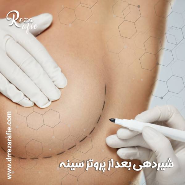 شیردهی بعد از پروتز سینه