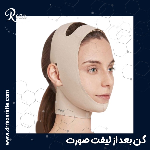 گن بعد از لیفت صورت