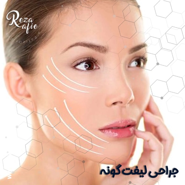 جراحی لیفت گونه